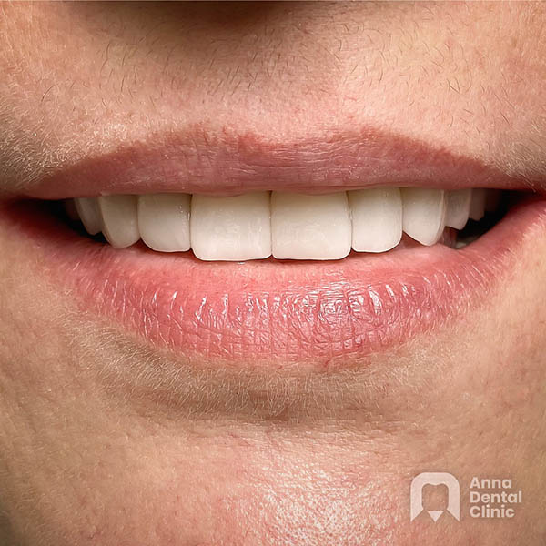 Metamorfoza uśmiechu | Bożena