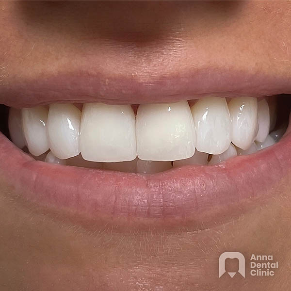 Metamorfoza uśmiechu | Melina