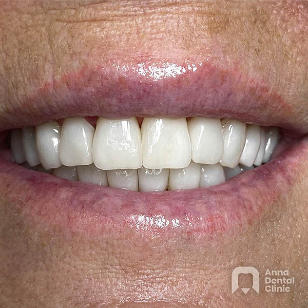 Metamorfoza uśmiechu | Kristina