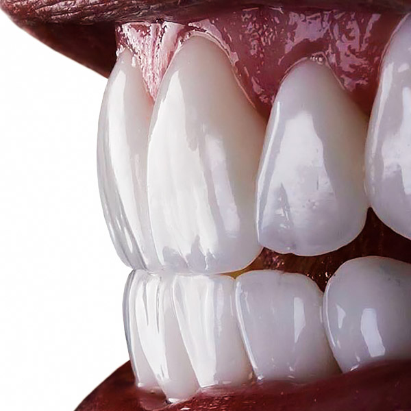 Teeth Veneers