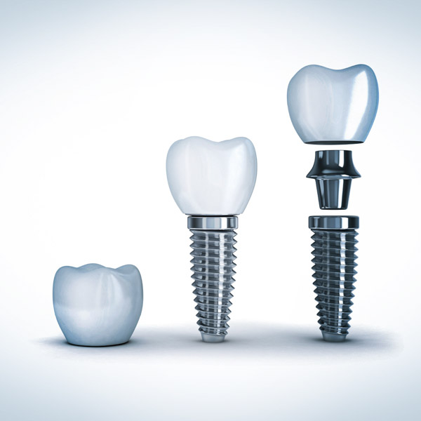 Implanty dentystyczne